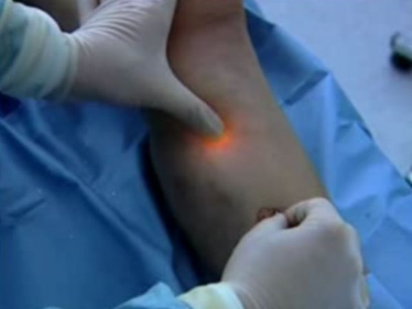 Тромбофлебит