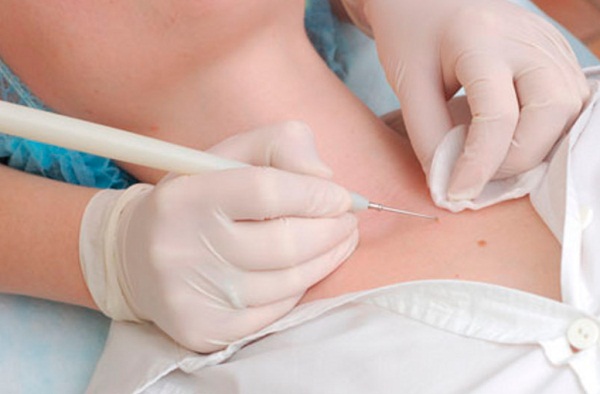 Хирургическое вмешательство