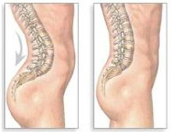 Лордоз позвоночника