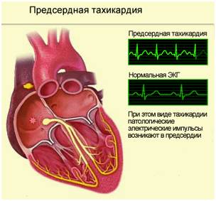 Тахикардия во время беременности