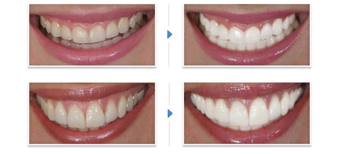 Визуального отбеливания