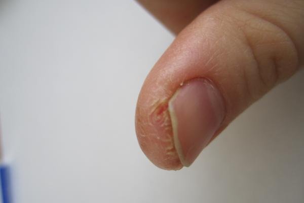 Трескающая кожа на пальцах рук около ногтей