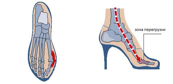 Причины боли косточки большого пальца на ноге