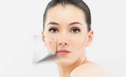 Прыщи на лице