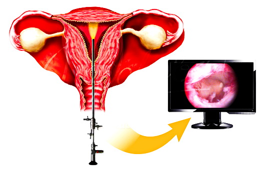 Изображение с камеры при гистероскопии