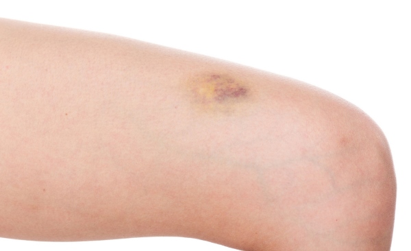 Появление синяков без ушибов