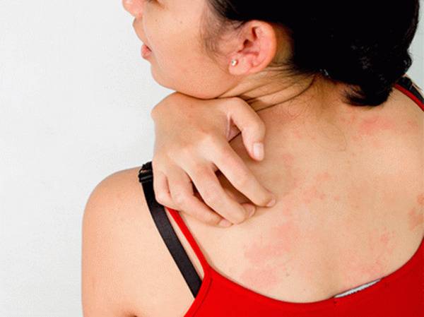 Чешется кожа