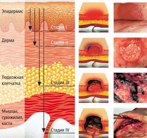 Развитие пролежней