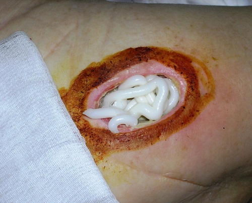 Лечение пролежней