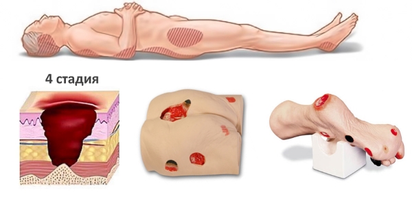 Пролежни 4 стадии