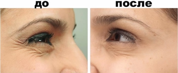 До и после шлифовки морщин на лице