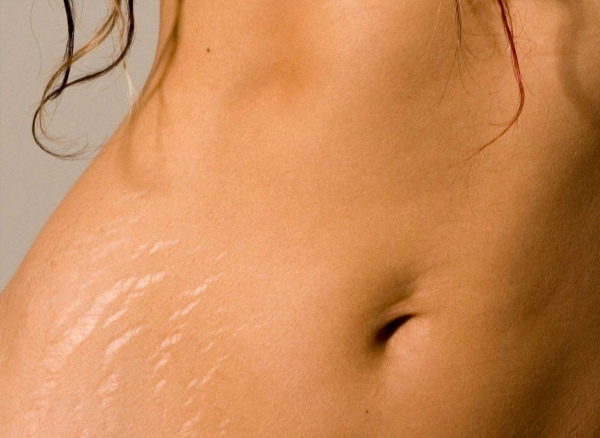 Борьба с растяжками