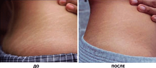 До и после использования мумие от растяжек