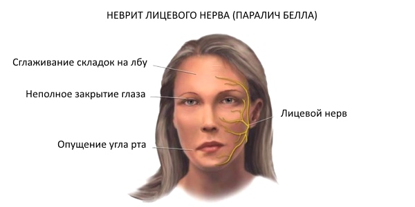 Неврит лицевого нерва