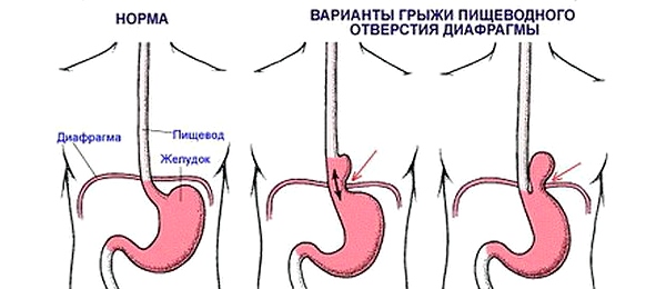Варианты грыжи пищевого отверстия диафрагмы