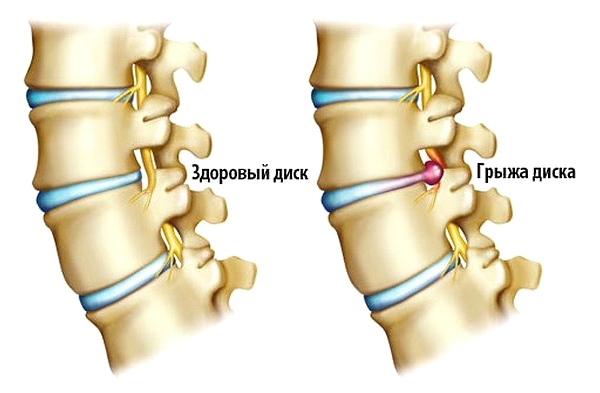 Грыжа межпозвоночного диска