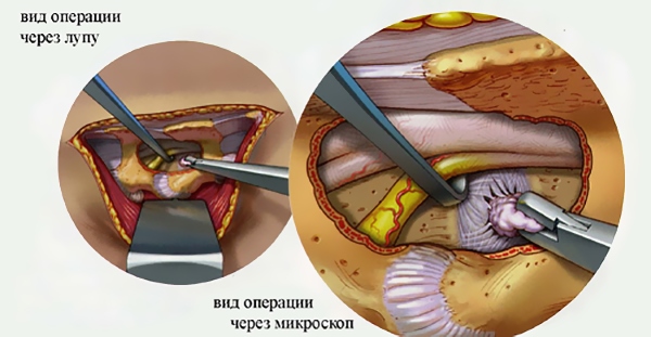 Оперативное лечение грыжи шейного отдела позвоночника
