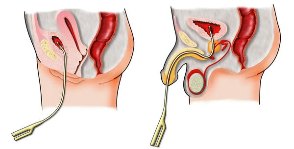 Заполнение мочевого пузыря контрастом перед цистографией