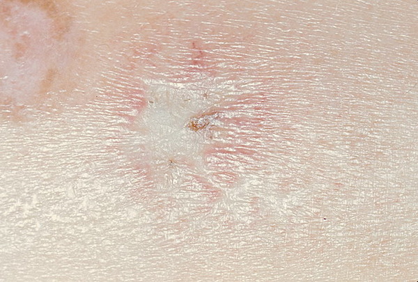 Атрофия кожного покрова