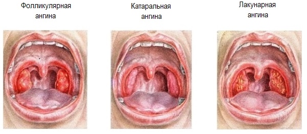 Формы ангины