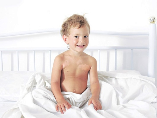 Витилиго у ребенка