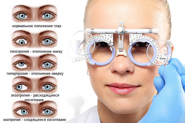 Виды косоглазия
