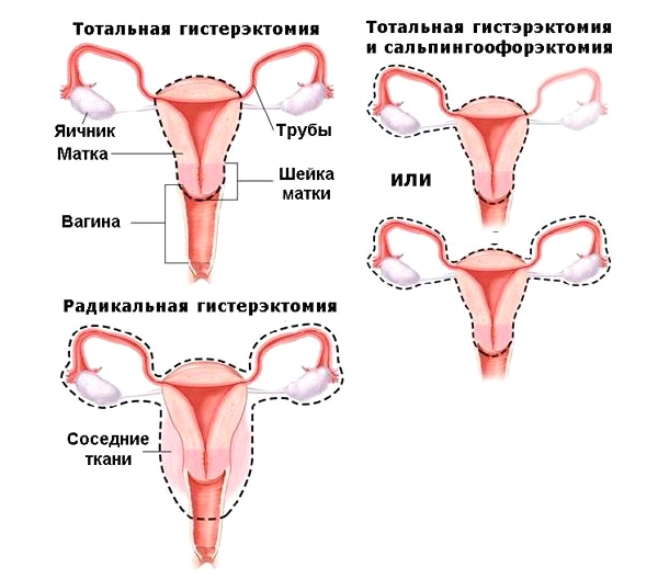 Виды гистерэктомии