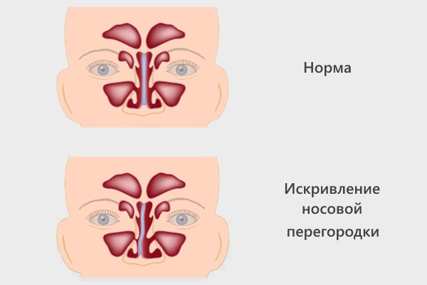 Искривление носовой перегородки