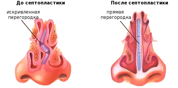 Септопластика