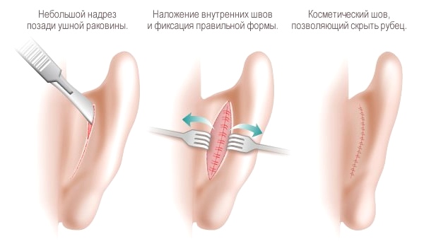 Хирургическое лечение лопоухости