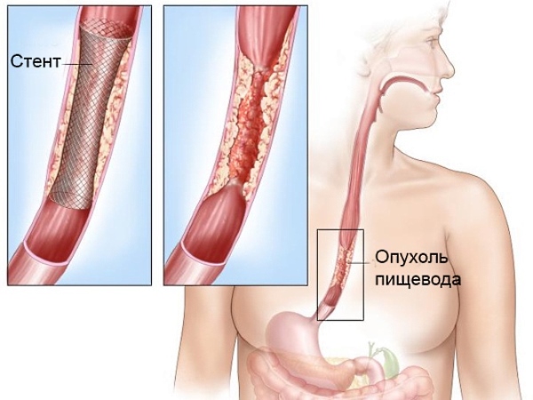Стентирование пищевода