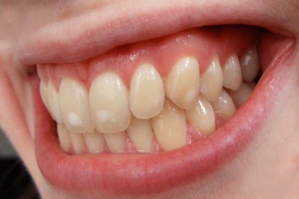 Белые пятна на зубах