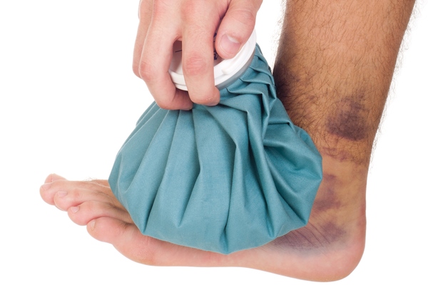 Отек из-за растяжения связок