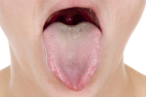 Парестезия языка