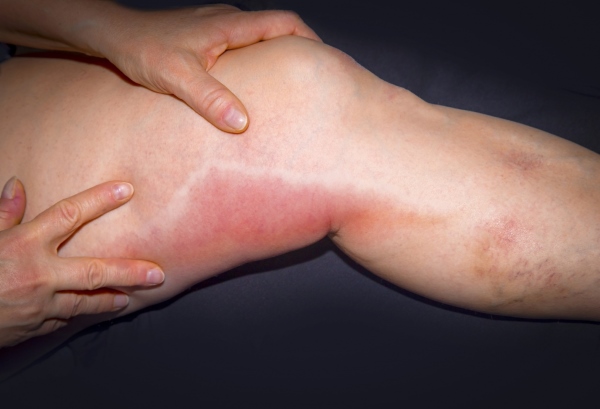 Перифлебит