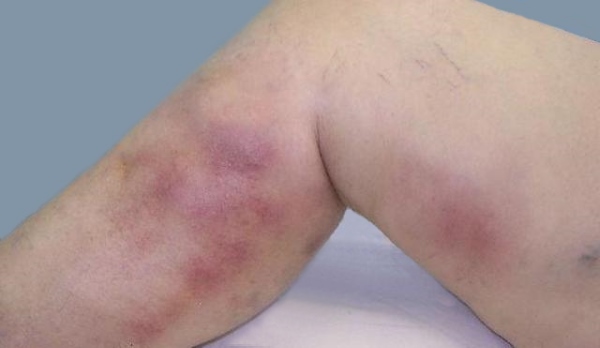 Перифлебит