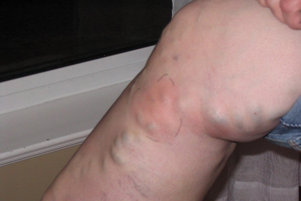 Флебит осложненный тромбозом