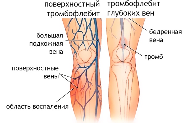 Тромбофлебит глубоких вен и поверхностный