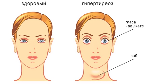 Пучеглазие при гипертиреозе