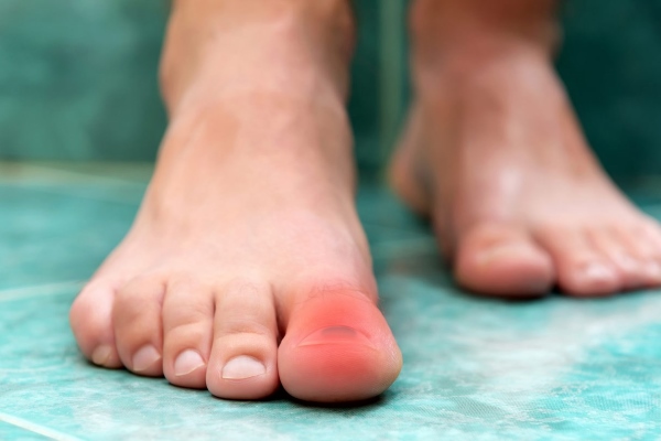 Ушиб пальца ноги