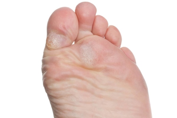 Сухой мозоль на большом пальце ноги