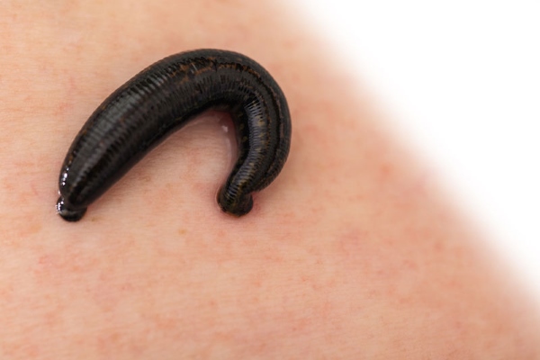 Лечение пиявками