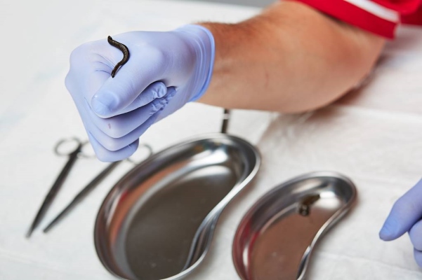 Гирудотерапия