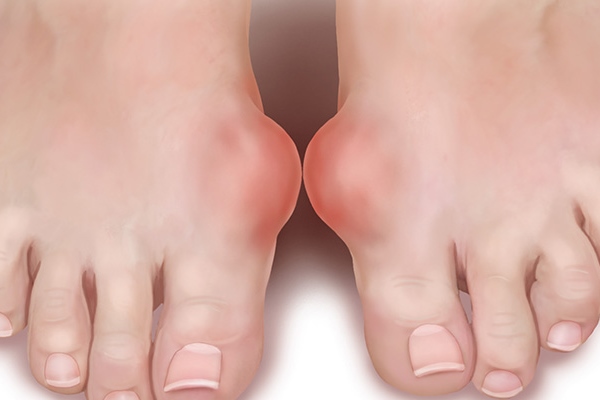 Шишки на больших пальцах ног