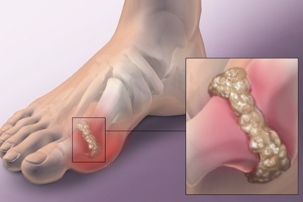 Отложение солей мочевой кислоты