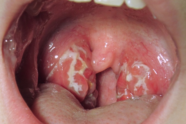 Налёт на миндалинах при тонзиллофарингите