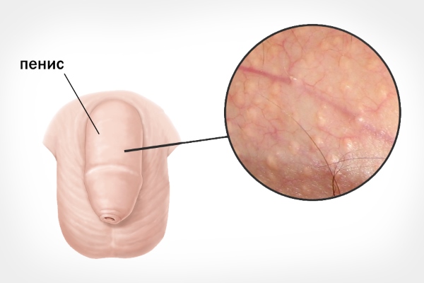 Перламутровые папулы полового члена