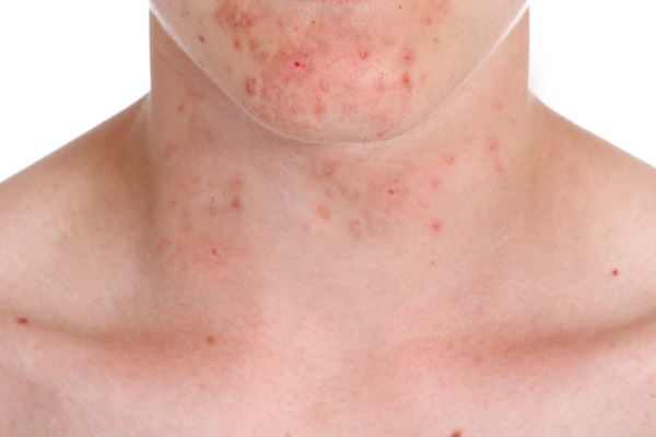 Прыщи на шее и подбородке