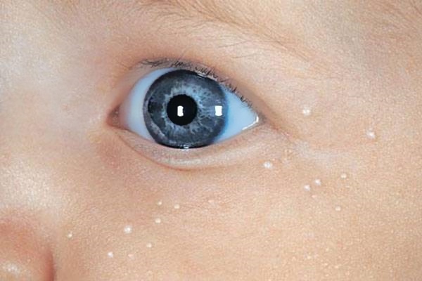 Белые прыщики на лице грудничка