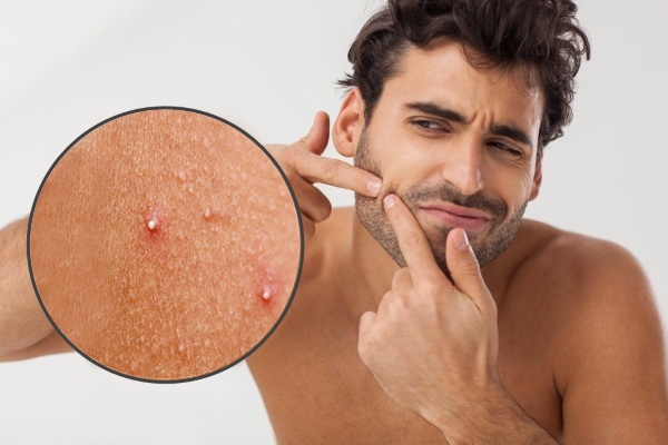 Белые прыщи на лице